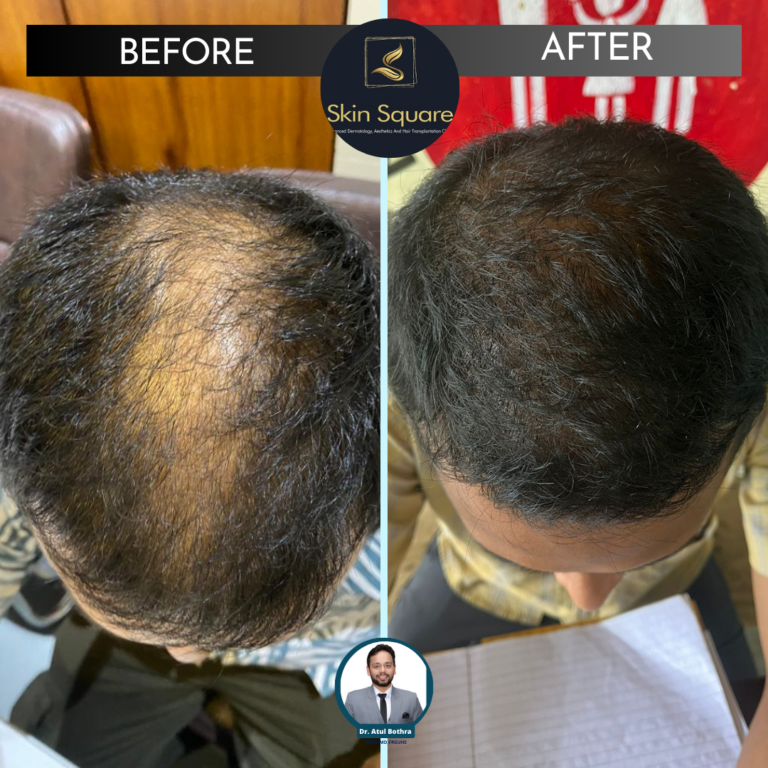 guwahati hair transplant