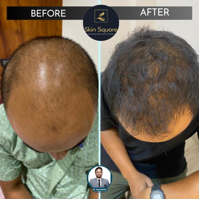 hair plantation cost in guwahati