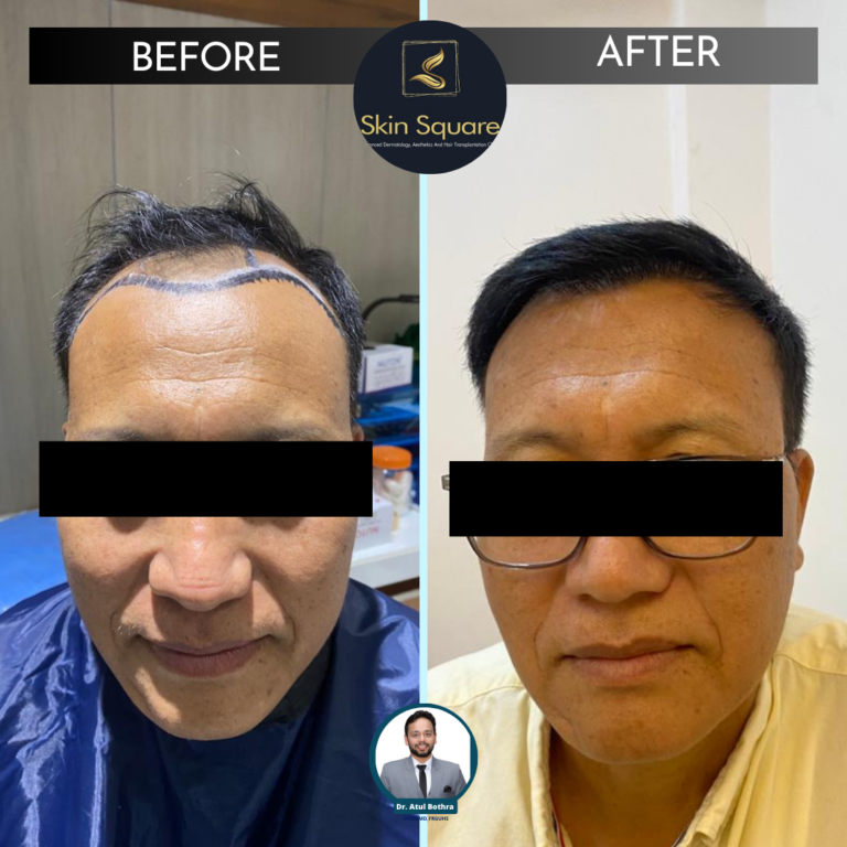 hair replacement in guwahati