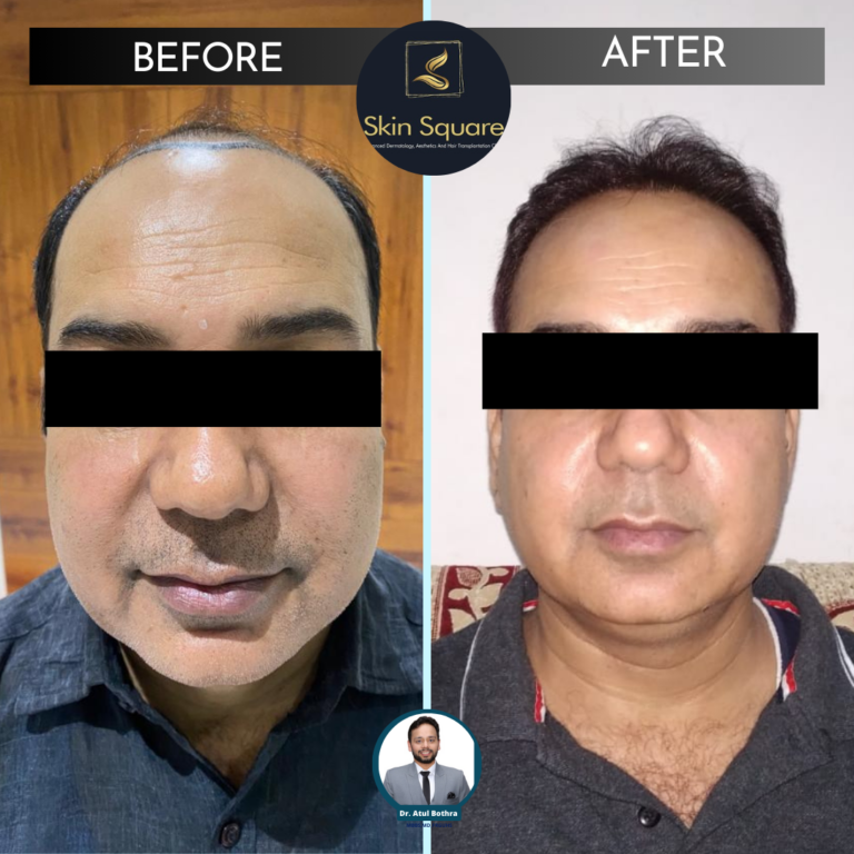 hair transplant cost guwahati