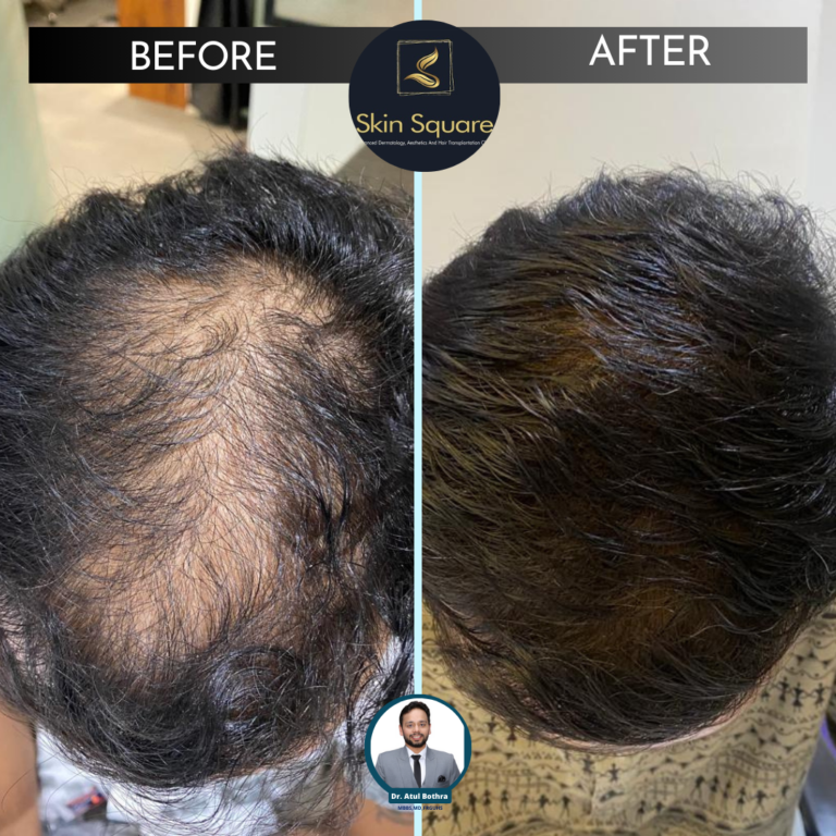 hair transplant in guwahati