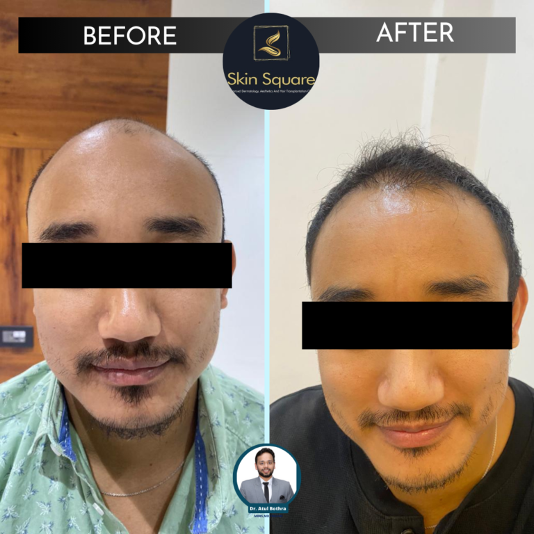non surgical hair solution guwahati